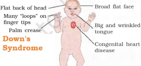 Down’s Syndrome