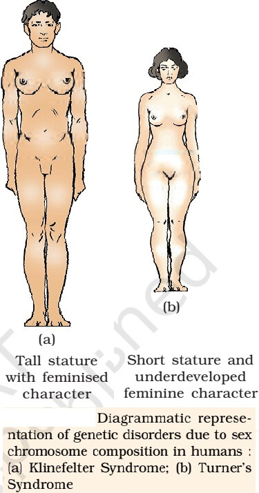 Klinefelter’s Syndrome - Turner's Syndrome