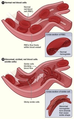 Sickle-Cell Anaemia