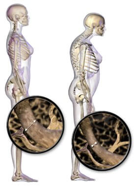 Osteoporosis